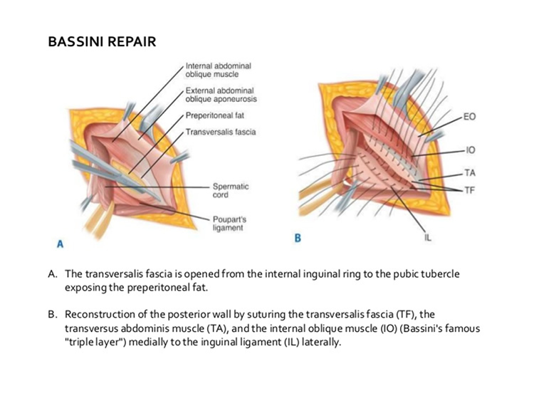 Non Mesh Inguinal Hernia Repair Kang Repair Youtube