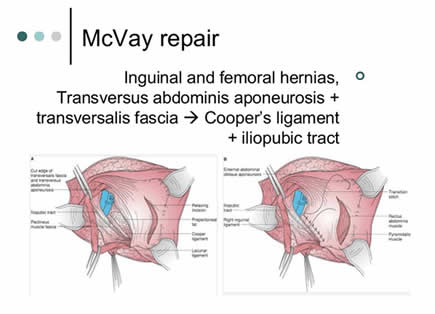 What You Should Know About the McVay Technique - Sports Hernia